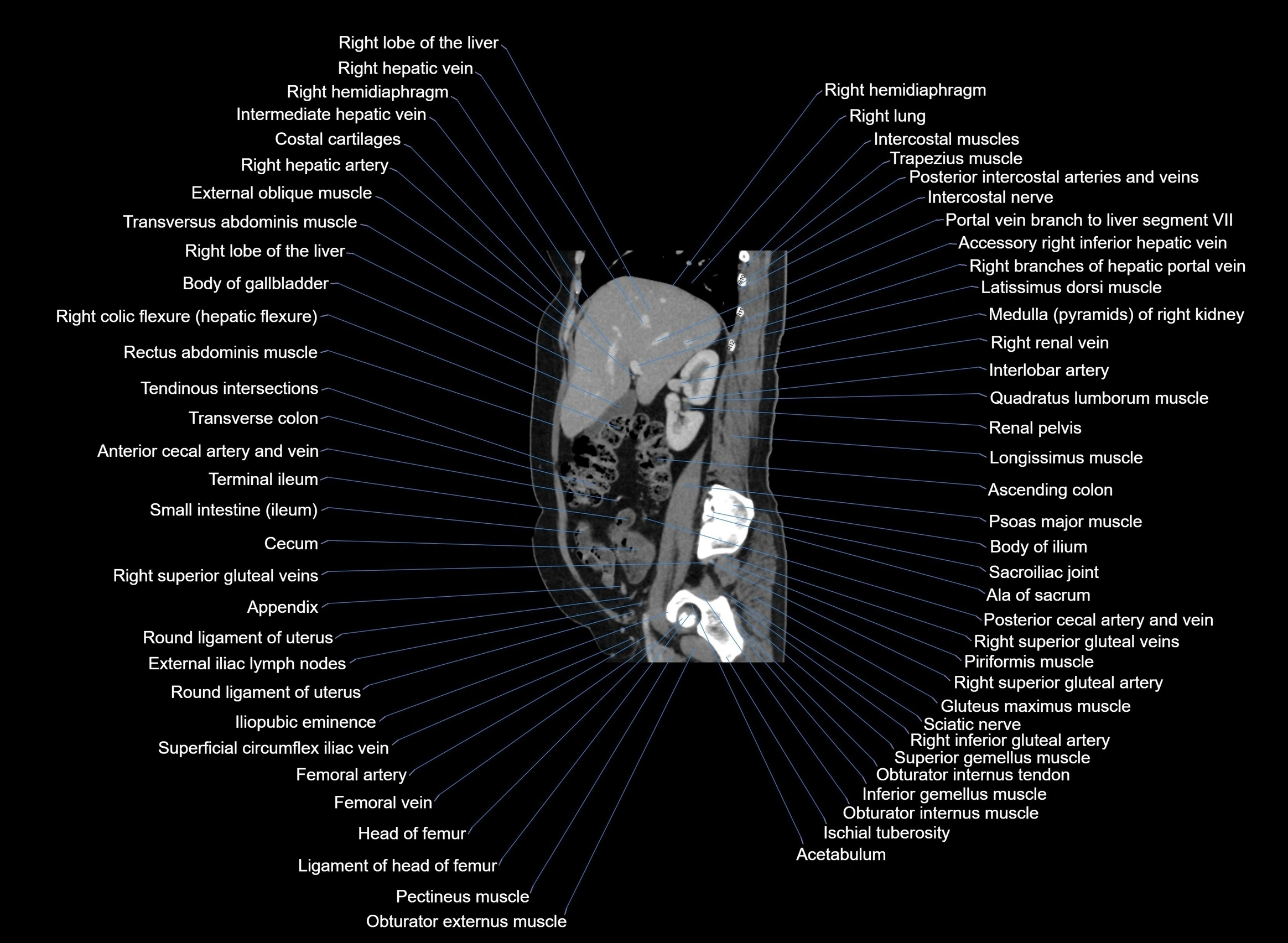 CT Abdomen sagittal cross sectional anatomy labelled radiology image -00078.webp